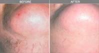 Chicago Laser Hair Removal